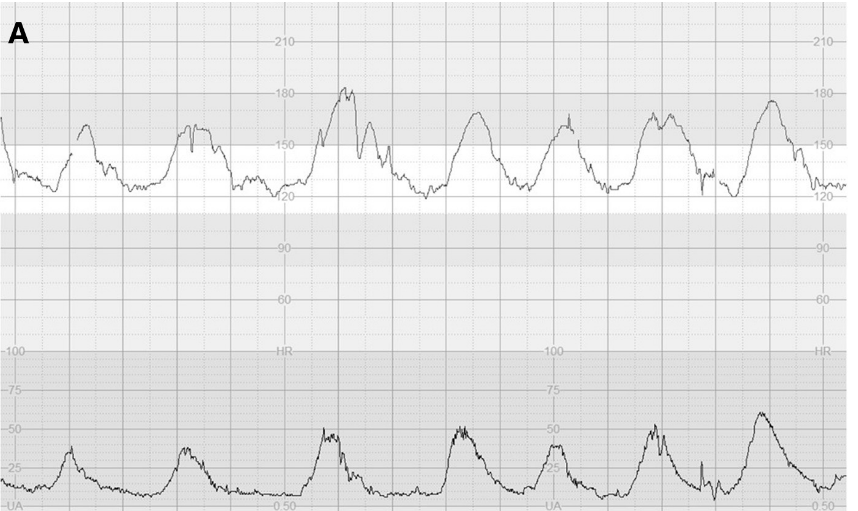 Example of double Mountain peak