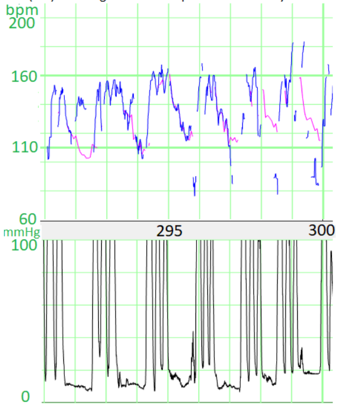 Example 2 of double Mountain peak