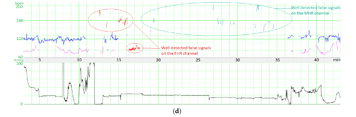 The Doppler sensor recording the maternal heart rate / harmonics instead of the true FHR (Boudet et al. 2022)