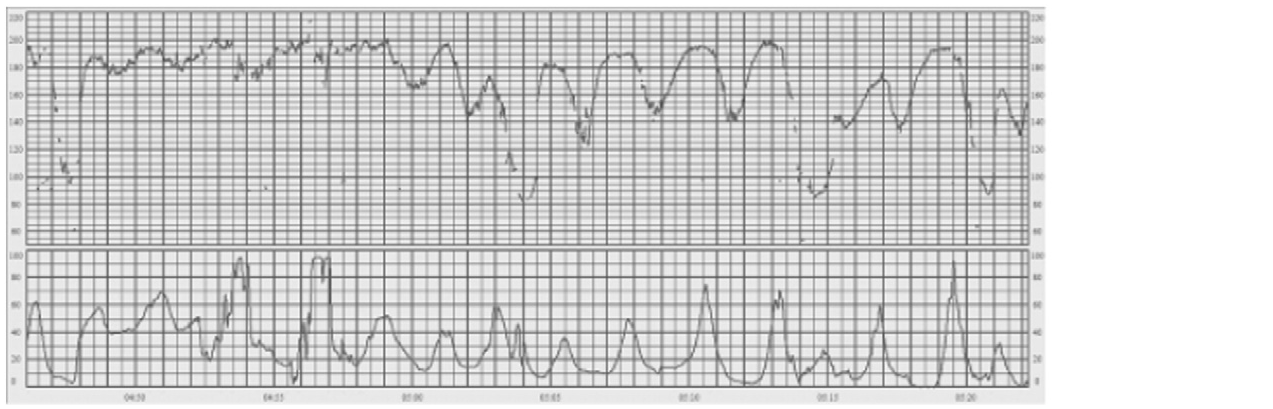 Late decelerations in the second half of the tracing (FIGO 2015, Fig. 8; external monitoring at 1, 2 and 3 cm/min)