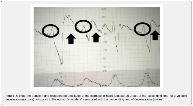 Figure 5 - "Overshoots" (arrows, exaggerated rise on the ascending limb) vs shoulders (circles), Al Fahdi & Chandraharan 2020