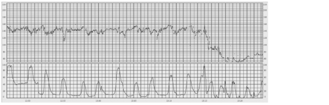 Prolonged deceleration (FIGO 2015, Fig. 9; external monitoring at 1, 2 and 3 cm/min)