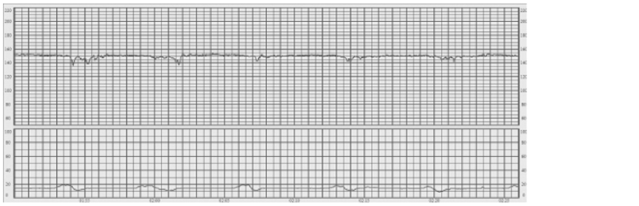 Reduced variability — bandwidth remains below 5 bpm (FIGO 2015, Fig. 5; external monitoring at 1, 2 and 3 cm/min)