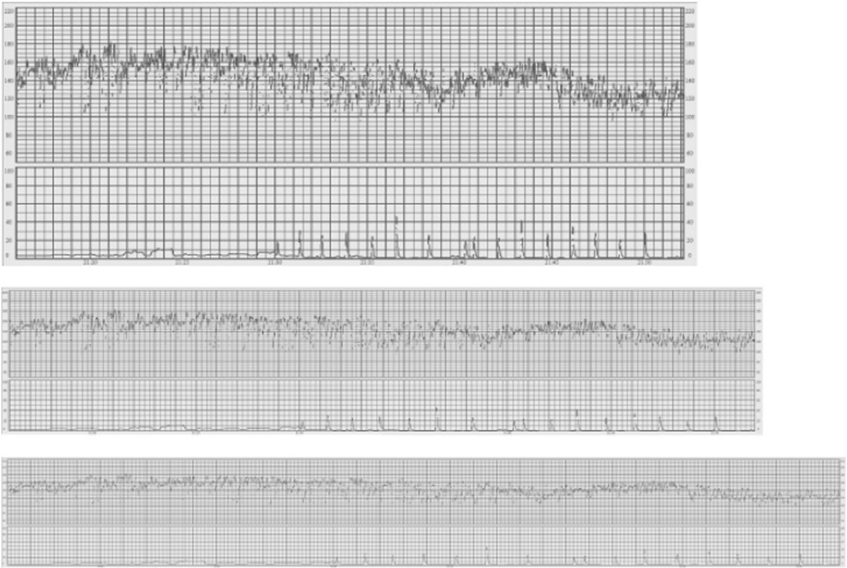 FIGO 2015 (Fig. 6) - Increased variability: saltatory pattern (internal monitoring at 1, 2 and 3 cm/min)