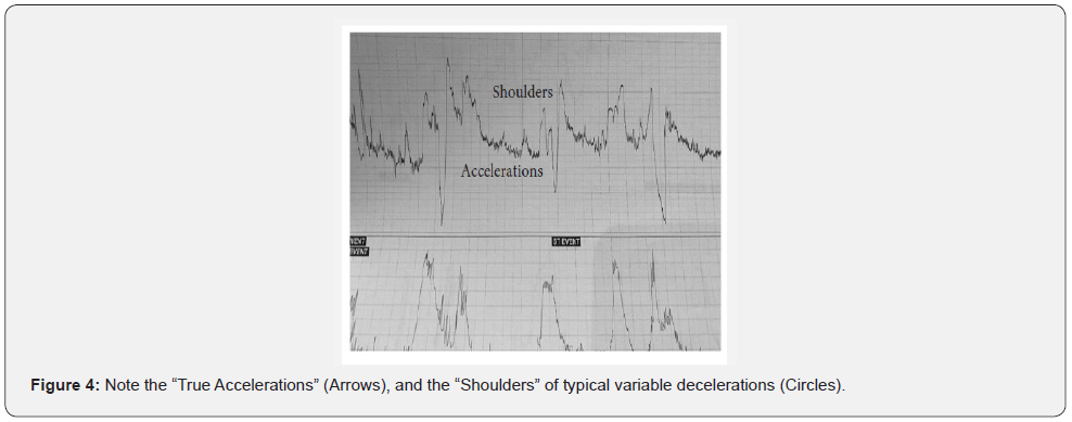 Figure 4 - "Shoulders" (circles) of typical variable decelerations vs true accelerations (arrows), Al Fahdi & Chandraharan 2020