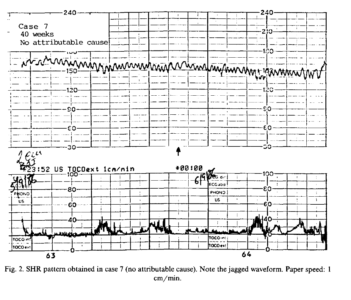 Atypical / saw-tooth (“shark teeth”) sinusoidal pattern