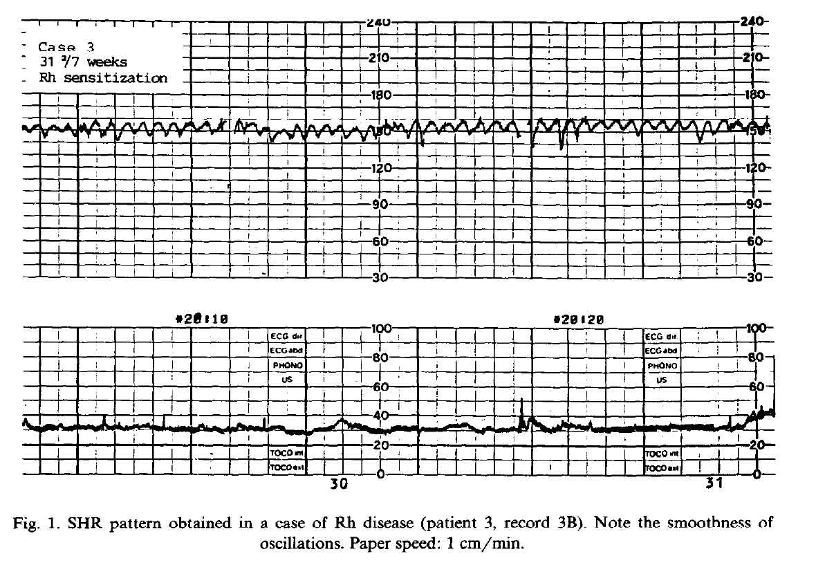 Typical (smooth) sinusoidal pattern in Rh disease with fetal anaemia (Graça et al. 1988, Fig. 1)