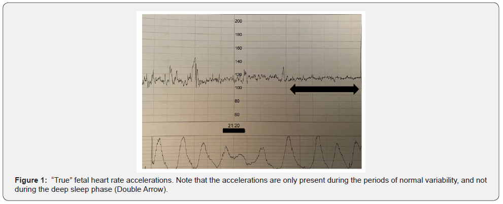 Figure 1 - True fetal heart rate accelerations, only during normal variability (Al Fahdi & Chandraharan 2020)