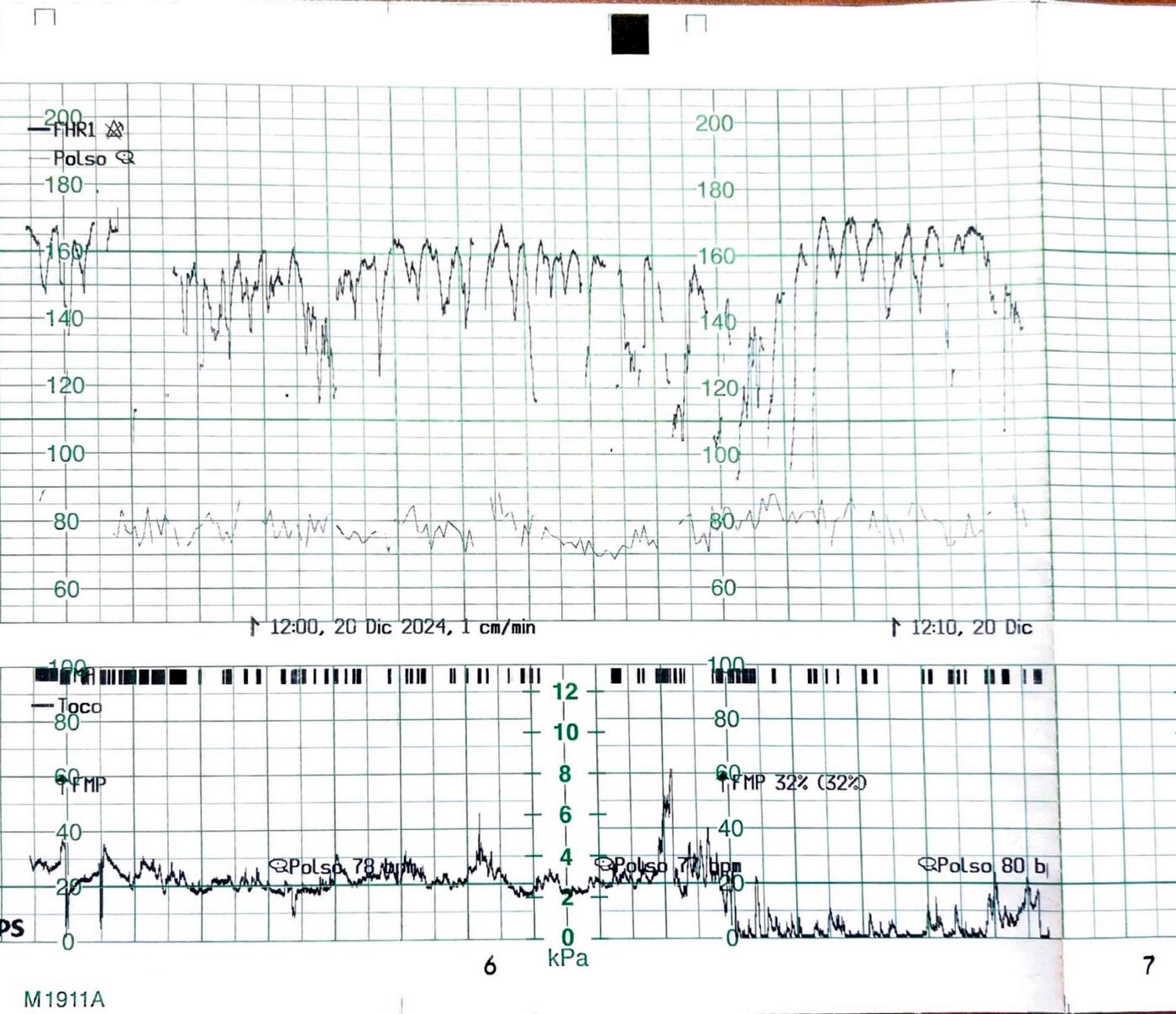 Derme et al. 2025 - "ZigZag" pattern detected during labour with intact membranes (dual intrauterine infection)