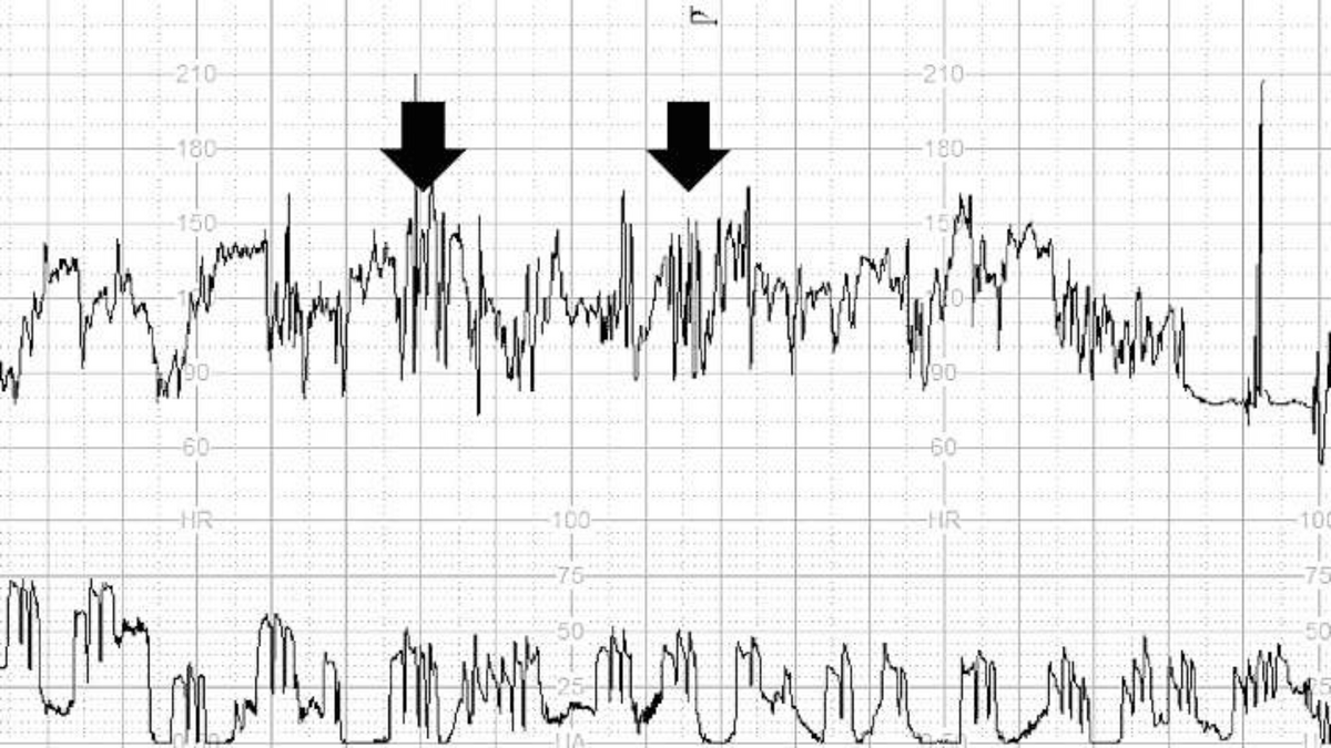 Consensus 2024 (Fig. 3) - "ZigZag" pattern