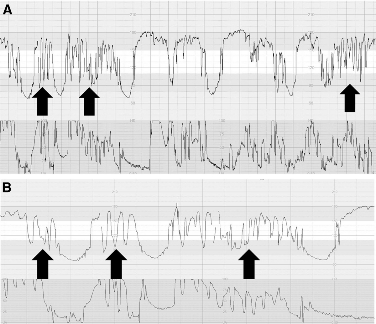 Jia 2023 (Fig. 6) - transient, abrupt, up-down fluctuation across the baseline (A: 1 cm/min, B: 3 cm/min)